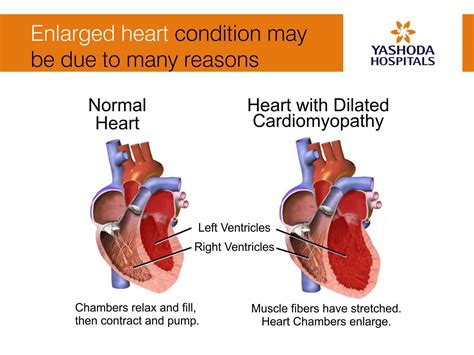 why is cardiac hypertrophy bad